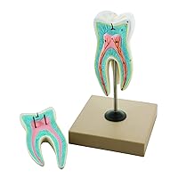 EISCO Labs Detailed Upper Triple Root Molar with Caries, Enlarged 15 Times, 2 Part Dental Model with Key Card for Educational Use