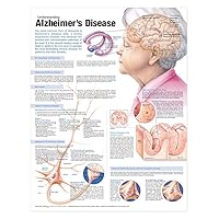 Understanding Alzheimer's Disease Anatomical Chart Understanding Alzheimer's Disease Anatomical Chart Wall Chart