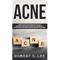 Acne: How to Cure Acne through Natural Remedies and Simple Habits. Say Goodbye to Pustules, Blackheads and Whiteheads for Good! Acne: How to Cure Acne through Natural Remedies and Simple Habits. Say Goodbye to Pustules, Blackheads and Whiteheads for Good! Hardcover Paperback