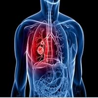 What Is Lung Cancer?