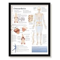 Framed Medical Poster Osteoarthritis 22