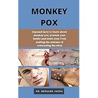 MONKEY POX: Exposed facts to know about monkey pox; prevent your family and loved ones from making the mistake of contracting the virus
