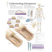 Understanding Osteoporosis chart: Laminated Wall Chart