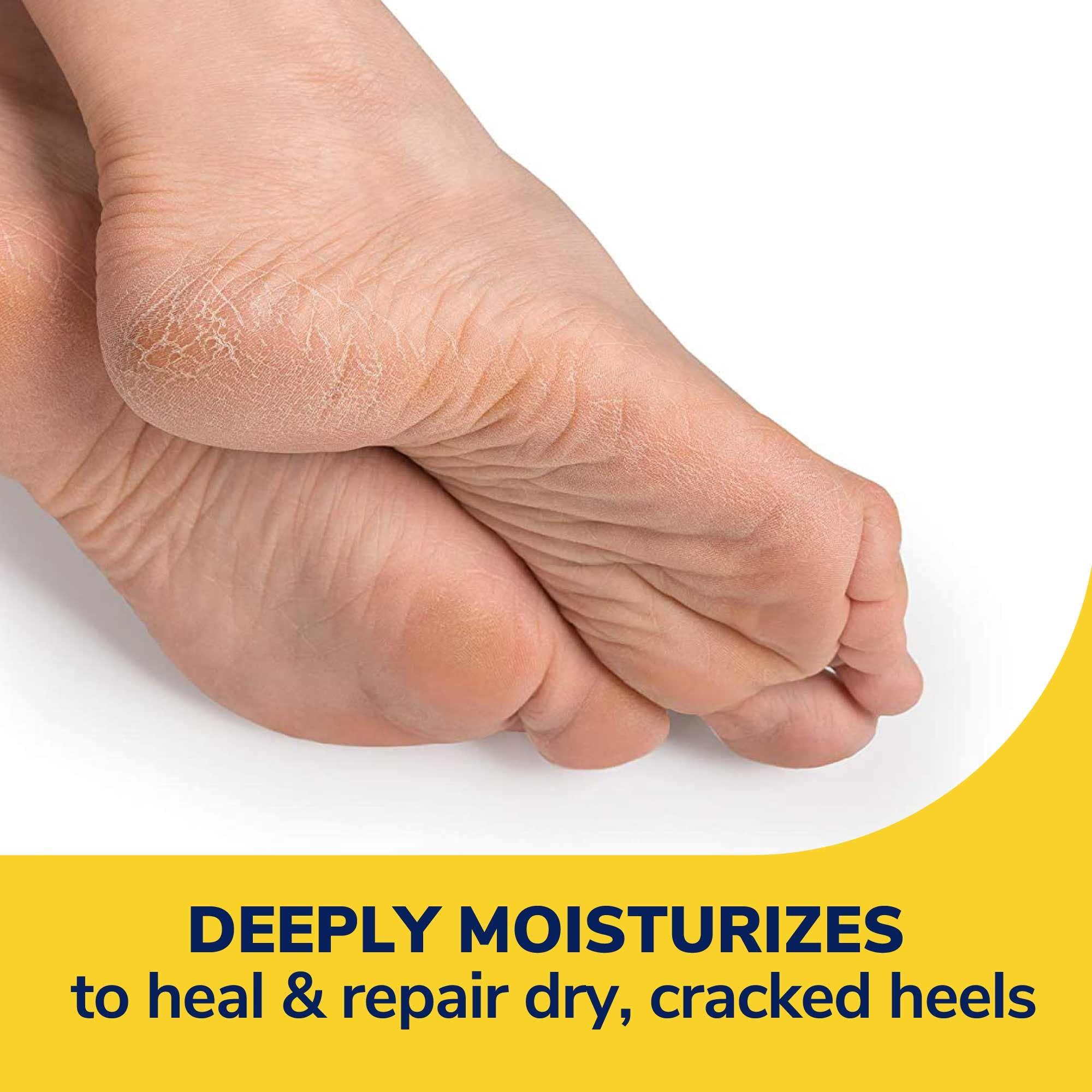 Dr. Scholl’s Severe Cracked Heel Repair Restoring Balm 2.5oz, with 25% Urea for Dry, Cracked Feet, Heals and Moisturizes for Healthy Looking Feet, Foot Care, Epsom Salt Soothes, Safe for Diabetics