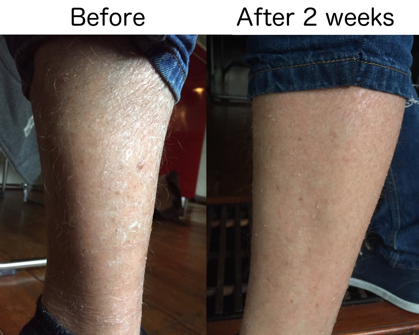 G16 Skin Repair Lotion, Excellent Ichthyosis Treatment Cream, Outstanding Results in 2 Weeks by G16