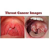 Throat Cancer : Causes , Treatment and Life Expectancy