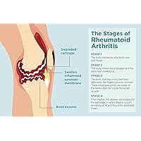 What is Rheumatoid Arthritis? Ayurveda aspects of Rheumatoid Arthritis:: Medical aspects of Rheumatoid Arthritis: