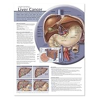 Understanding Liver Cancer Anatomical Chart Understanding Liver Cancer Anatomical Chart Wall Chart