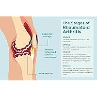 What is rheumatoid arthritis?: What’s the age of onset for rheumatoid arthritis? Who gets rheumatoid arthritis?