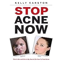 Stop Acne Now: This Is Me and This Is My Secret On How to Treat Acne Stop Acne Now: This Is Me and This Is My Secret On How to Treat Acne Kindle
