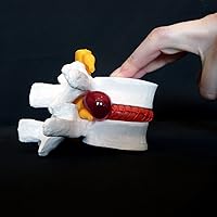 Superdental Anatomical Human Lumbar disc herniation demonstration model Human Spine Yellow/White