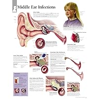 Middle Ear Infection chart: Laminated Wall Chart