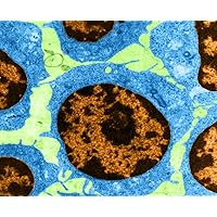 White Blood Cells in Leukemia (TEM) Poster Print by Science Source (36 x 24)