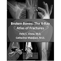 Broken Bones: The X-Ray Atlas of Fractures Broken Bones: The X-Ray Atlas of Fractures Kindle