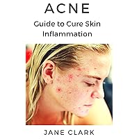 ACNE: Guide to Cure Skin Inflammation ACNE: Guide to Cure Skin Inflammation Kindle Paperback
