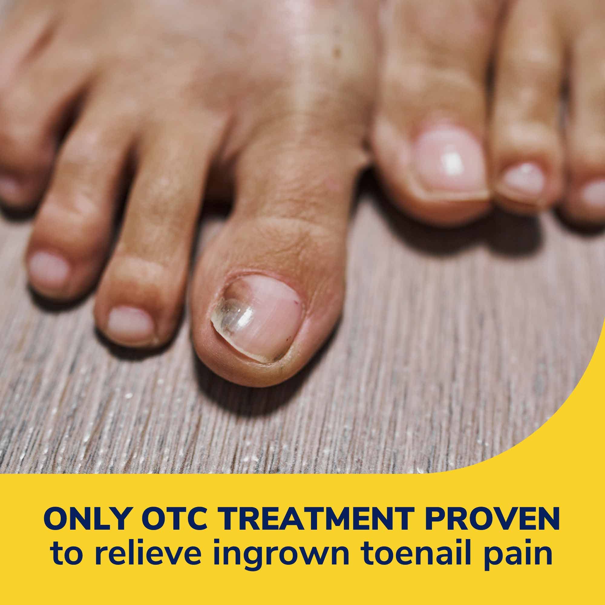 Dr. Scholl's Ingrown Toenail Pain Reliever, 0.3oz // Medicated Gel Softens Nails for Easy Trimming and Foam Ring and Bandage Protect the Affected Area