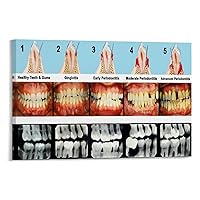 Retro Periodontal Disease Stages Dentist Poster Dental Science Poster Canvas Painting Posters And Prints Wall Art Pictures for Living Room Bedroom Decor 36x24inch(90x60cm) Frame-style