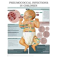 Pneumococcal infections in children e chart: Full illustrated