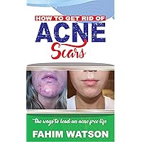 HOW TO GET RID OF ACNE SCARS: The ways To Lead An Acne Free Life