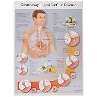 3B Scientific VR2711L Glossy UV Resistant Laminated Paper Pathologie Du Reflux Gastrique Anatomical Chart (Gastroesophageal Reflux Disease Anatomical Chart, French), Poster Size 20