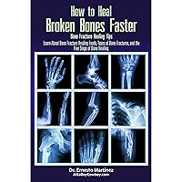 How to Heal Broken Bones Faster. Bone Fracture Healing Tips: Learn About Bone Fracture Healing Foods, Types of Bone Fractures, and the Five Stages of Bone Healing How to Heal Broken Bones Faster. Bone Fracture Healing Tips: Learn About Bone Fracture Healing Foods, Types of Bone Fractures, and the Five Stages of Bone Healing Audible Audiobook Kindle Paperback Hardcover
