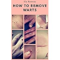 How to remove warts: Remove all warts from your body quickly and easily with the best home remedies