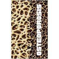 Osteoporosis Osteoporosis Kindle Paperback