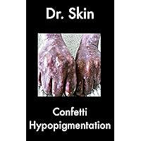 Confetti Hypopigmentation