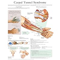 Carpal Tunnel Syndrome e chart: Full illustrated