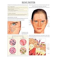 Sinusitis e chart: Full illustrated