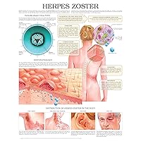Herpes Zoster e chart: Full illustrated