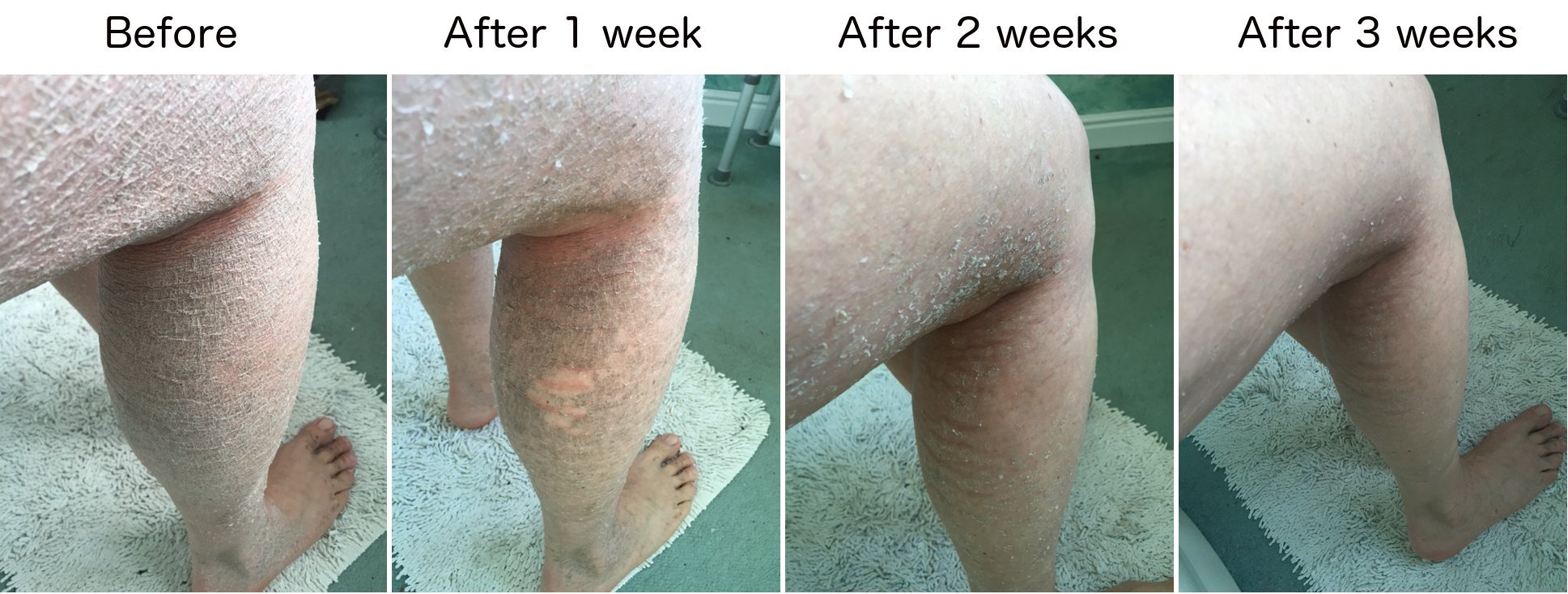 G16 Skin Repair Lotion, Excellent Ichthyosis Treatment Cream, Outstanding Results in 2 Weeks by G16