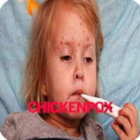 Chickenpox Disease