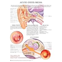 Acute otitis media e chart: Full illustrated