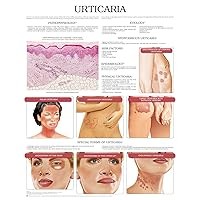 Urticaria e chart: Full illustrated