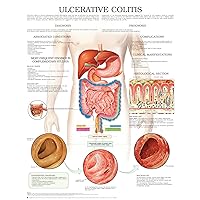 Ulcerative colitis e chart: Full illustrated