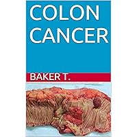 COLON CANCER (WHAT YOU NEED TO KNOW Book 6) COLON CANCER (WHAT YOU NEED TO KNOW Book 6) Kindle