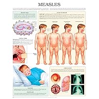 Measles e chart: Full illustrated