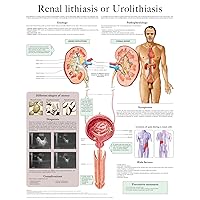 Renal lithiasis or Urolithiasis e chart: Full illustrated