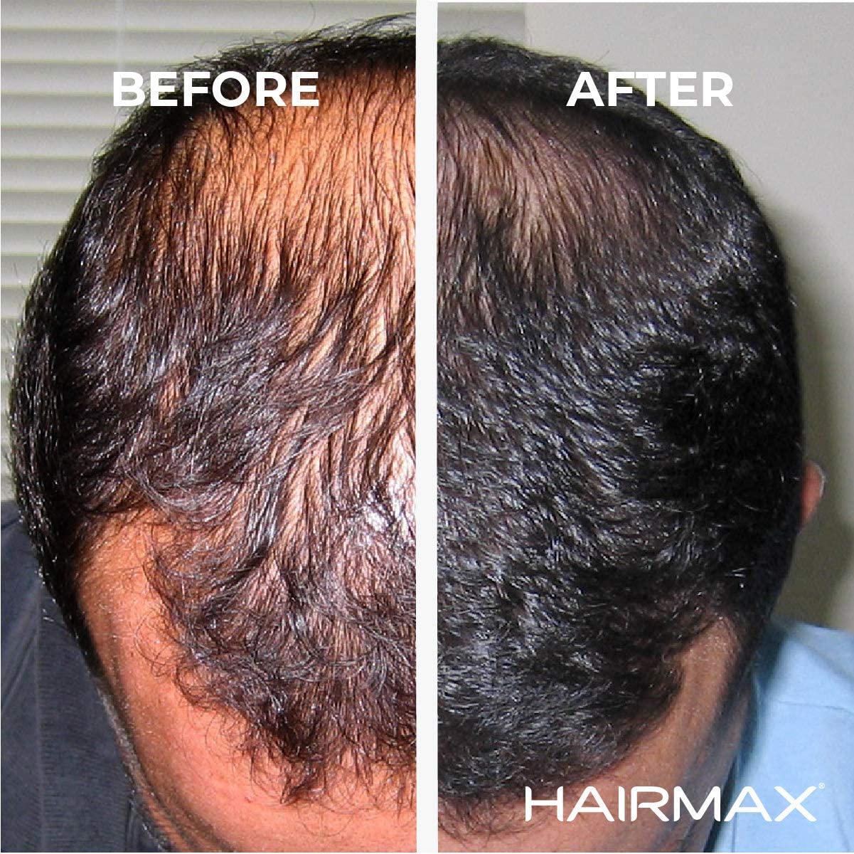 Mua HairMax Laser Hair Growth Band LaserBand 82 (FDA Cleared). Full Scalp  Hair Loss Treatment for men and women that Stimulates Hair Growth, Reverses  Thinning Hair, and Regrows Denser, Fuller Hair trên