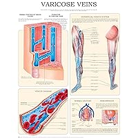 Varicose veins e-chart: Quick reference guide