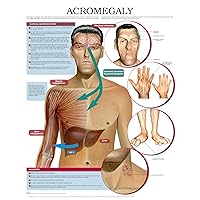 Acromegaly e chart: Full illustrated