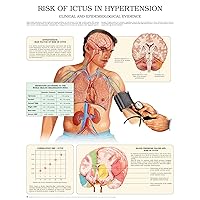 Risk of ictus in hypertension e chart: Full illustrated