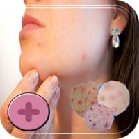 Treatment for Chickenpox