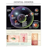 Genital Herpes e chart: Full illustrated