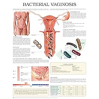 Bacterial vaginosis e chart: Full illustrated Bacterial vaginosis e chart: Full illustrated Kindle