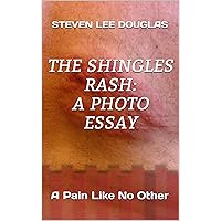 The Shingles Rash: A Photo Essay: A Pain Like No Other The Shingles Rash: A Photo Essay: A Pain Like No Other Kindle