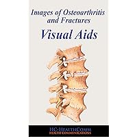 Images of Osteoarthritis and Fractures: Visual Aids, Full Illustrated
