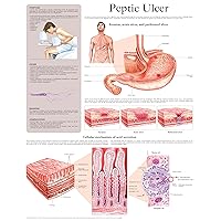 Peptic Ulcer e-chart: Full illustrated