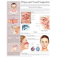 Polyps and Nasal Congestion e-chart: Full illustrated